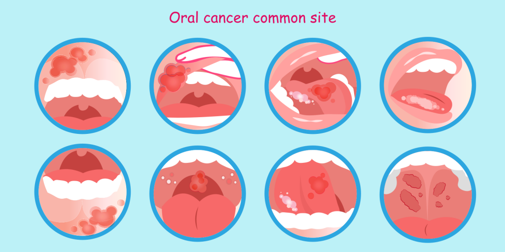 Oral Cancer AIIORE Blog
