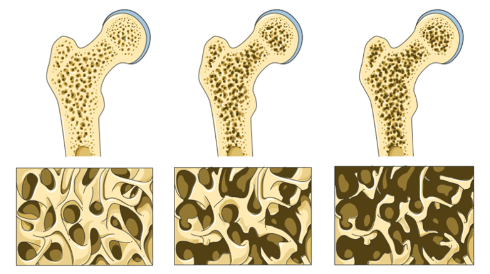 bone-density
