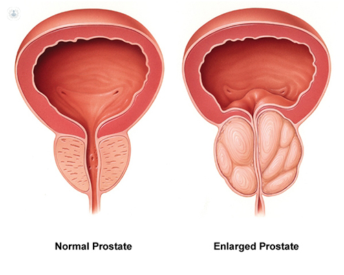 normal-prostate